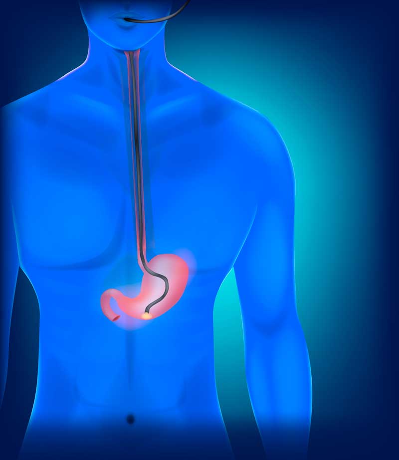 Endoscopia Digestiva Alta